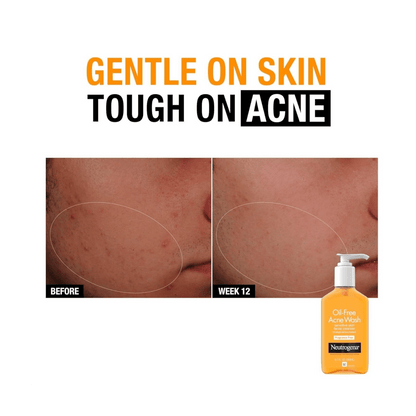 Neutrogena oil-free acne wash advertisement showing before and after effects on skin.
